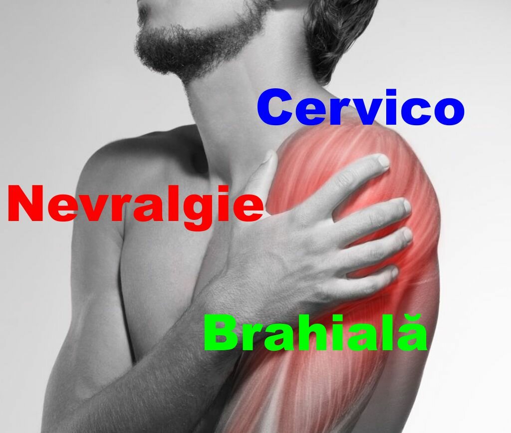 Nevralgia cervico-brahiala - cauze, simptome si tratament | Centrokinetic